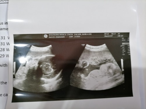 Alam nyo po ba basahin ang ultrasound pic na 'to? Sabi sa amin BOY daw 😊
