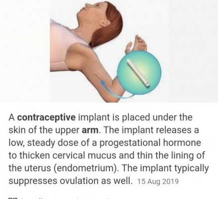 Contraceptive implant