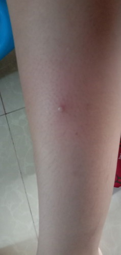 Simula nung manganak ako (ftm), tinutubuan na ako ng di ko masabi kung pigsa ba ito o tagyawat..