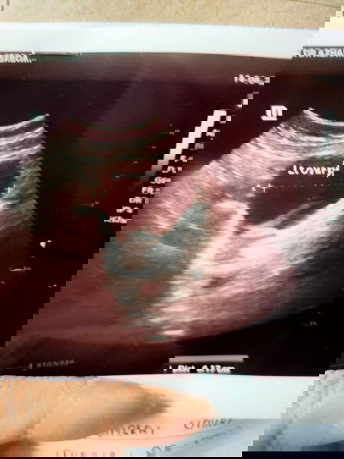 Cyst atau pregnant?