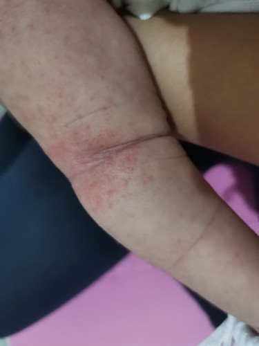 Hi everyone, first time mom here, normal lang po kaya itong rashes sa braso ng baby ko?