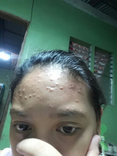 PIMPLE PROBLEM