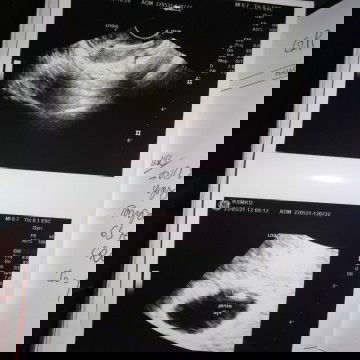 Nwp (Hamil dan Menyusui)