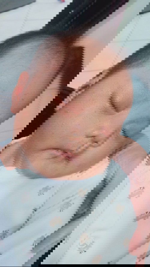 Anong klaseng rashes?