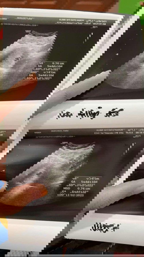 Kantung rendah doktor cakap threaten miscarriage