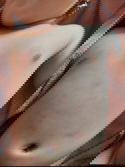 Bé bị nổi hột