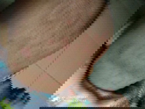 Cacar air atau scabies