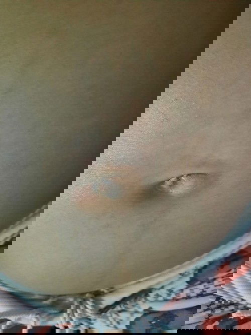 ท้องมีรอยแดง