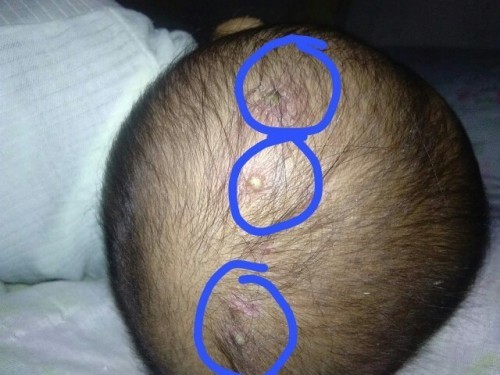 Timbul bisul di kepala si kecil