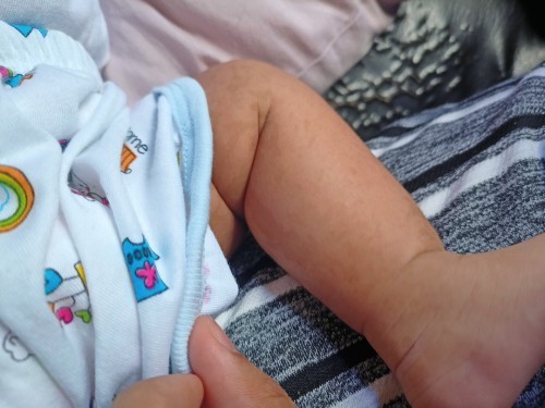 Hi mga mommy, ask ko lang kung may naka experience na ng ganito sa balat ni baby?