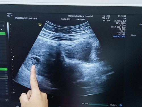 เจอตัวน้องตอน 7 สัปดาห์ 6 วันค่ะ เป็นกำลังใจให้แม่ๆทุกคนด้วยนะค่ะ