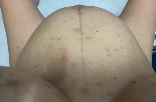 ผื่นเม็ดตุ่มดำๆแดงๆขึ้นเต็มตัวไปหมด