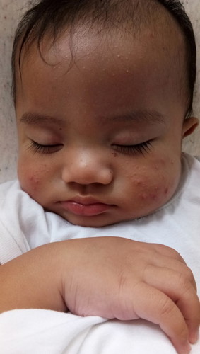 Baby Acne ni Eli