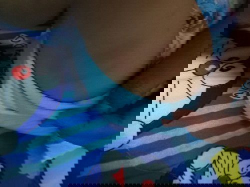 ฉีดวัคซีนเเล้วเป็นก้อนๆที่ขาเริ่มมีรอยเเดงๆขึ้น