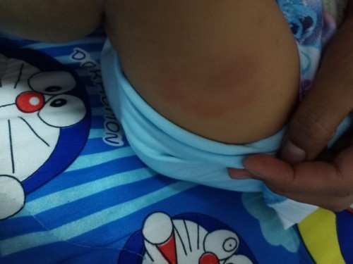 ฉีดวัคซีนเเล้วเป็นก้อนๆที่ขาเริ่มมีรอยเเดงๆขึ้น