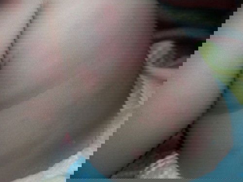 Alergi panas atau apa