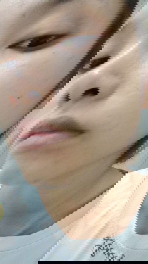 ผื่นคันมีเเม่ๆคนไหนเป็นบ้างคะ