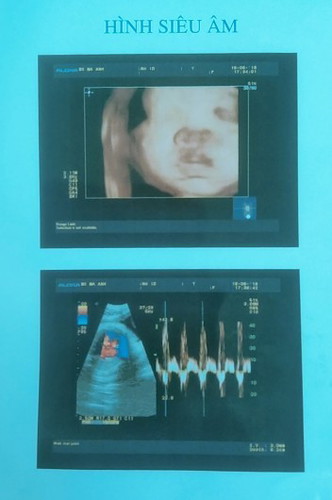 Thường bé xoay đầu thì bao lâu mới sinh vậy các mom.. nay ku được 32w. Đc 2050 gam rồi cô chú ơi 😍