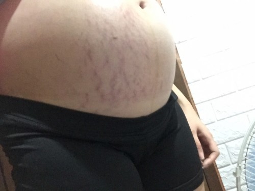Good day to all momsh out there! Ano po bang mabisang gamot para mawala kaagad ang stretch mark? 😃