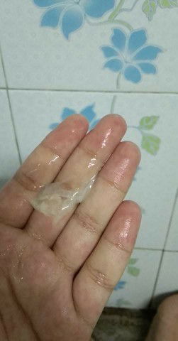 ตั้งครรภ์ 37+4 สัปดาห์