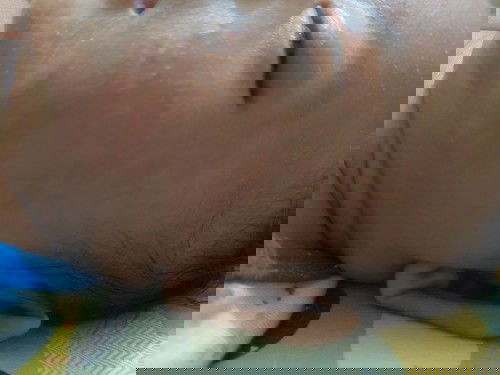 Bintik merah di pipi bayi