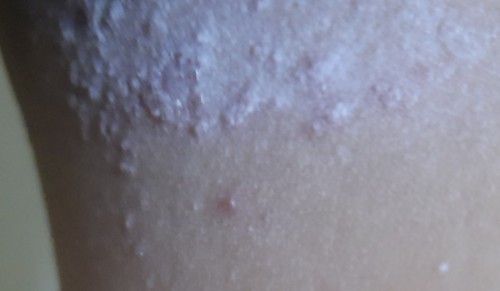 Rashes and Vaginal Itch
