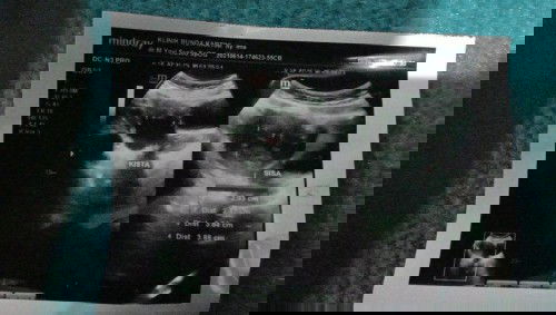 Apa gak apa apa 
Klau ada kista d perutku