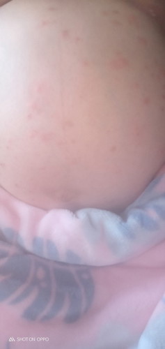 Skin allergy