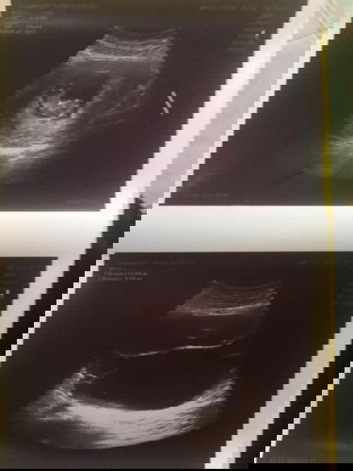 เป็นซีสต์ระหว่างตั้งครรภ์