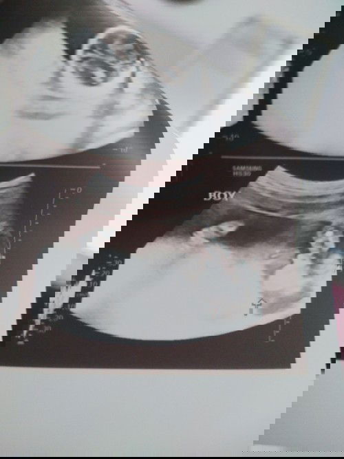 17weeks&6days may gender ang baby ko Sure na Kaya ito?Hindi ko nb need magpaUltrasound for gender?