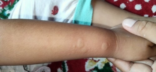 Biduran sembuh muncul lagi