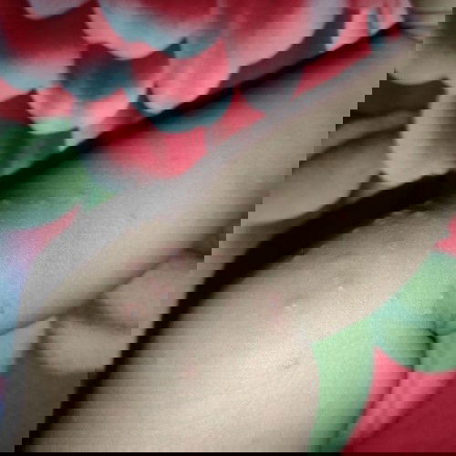 Bintik merah pada bayi 10 bulan