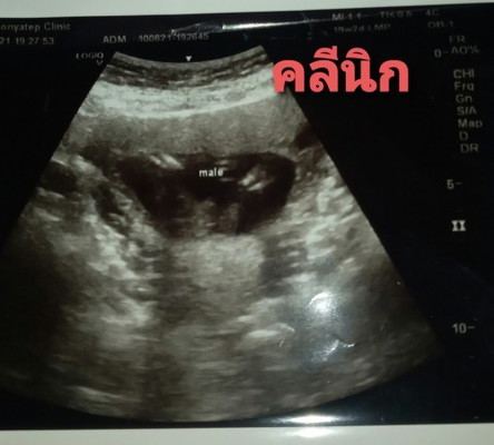 สับสนเพศลูก ญ.ช