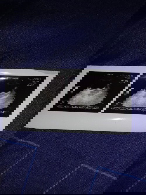 USG dan hpht kenapa berbeda ya dok