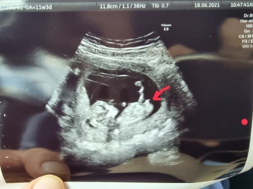 12 weeks หมอเดาว่า ผู้ชาย 99%
เพราะว่ามีจะงอยชัดมาก รบกวนถามแม่ๆ มีโอกาสเป็นลูกสาวไหมคะ ^^