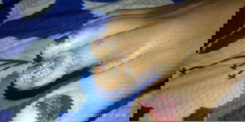 Luka di telunjuk kaki