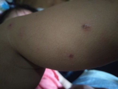 Insect bite na kinamot at naging sugat