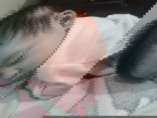 Trị Lép đầu ở trẻ 4 tháng tuổi