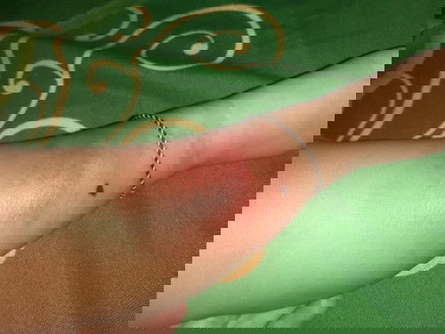 Tiba-tiba Lebam di bagian betis