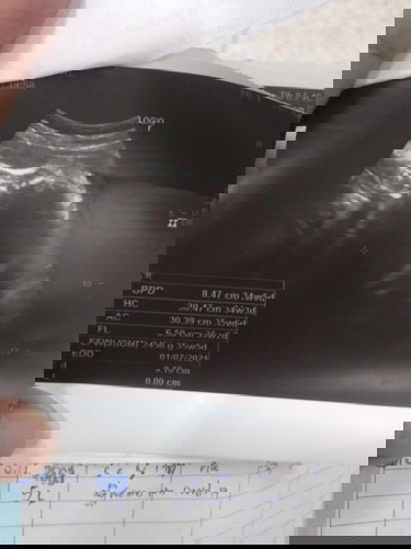 ขอถามแม่ๆในนี้หน่อยได้ไหมค่ะ คือกำหนดคลอดเป็นวันที่ 7 ก.ค. ซาวด์ครั้งสุดท้ายอายุครรภ์ 34+6 วีค