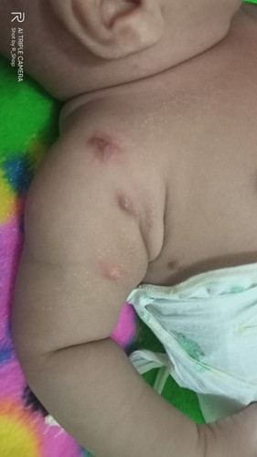 Mau tnya Bun.bayi saya bentol2 pindah2 & bekas hitam,sdh 3 Minggu mulai muncul yg pertma.usia 2.5bln