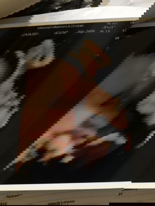 Berbagi pengalaman induksi dong moms🙏