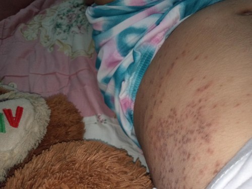 Tolong dong kasi tau ini kenapa ya? Dan bagaimana cara ngilangin nya ?gatel banget sampe ga bisa tdr