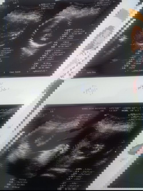 ท้องคนที่3ลูกหลงในคุณแม่อายุ38ปีคุณหมอบอกว่าน่าจะเป็นลูกสาวค่ะ ขอให้ได้ลูกสาวสมใจด้วยนะ