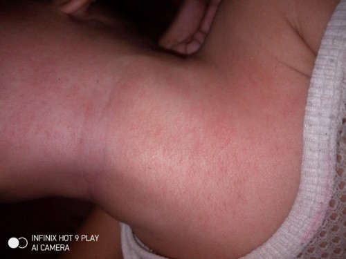 Rashes???? Bungang'araw????