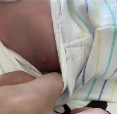Boils on baby butt