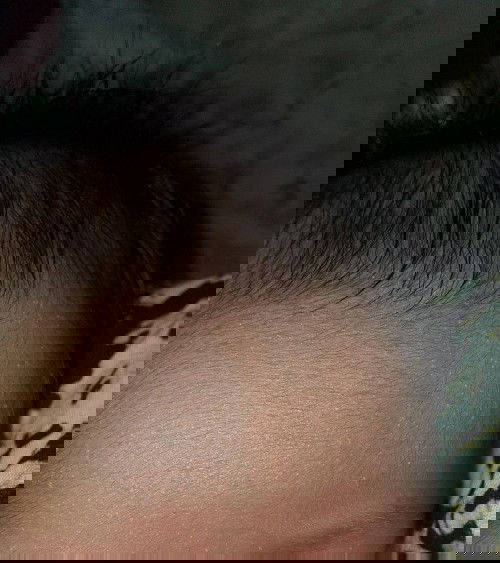 Jidat beruntusan putih