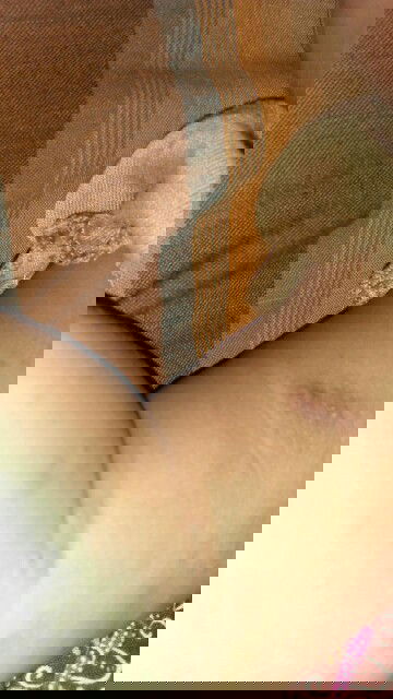 Gatal tak kunjung sembuh