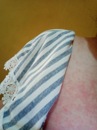 red & itchy rashes