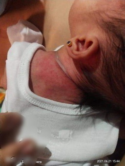 Rashes ni baby